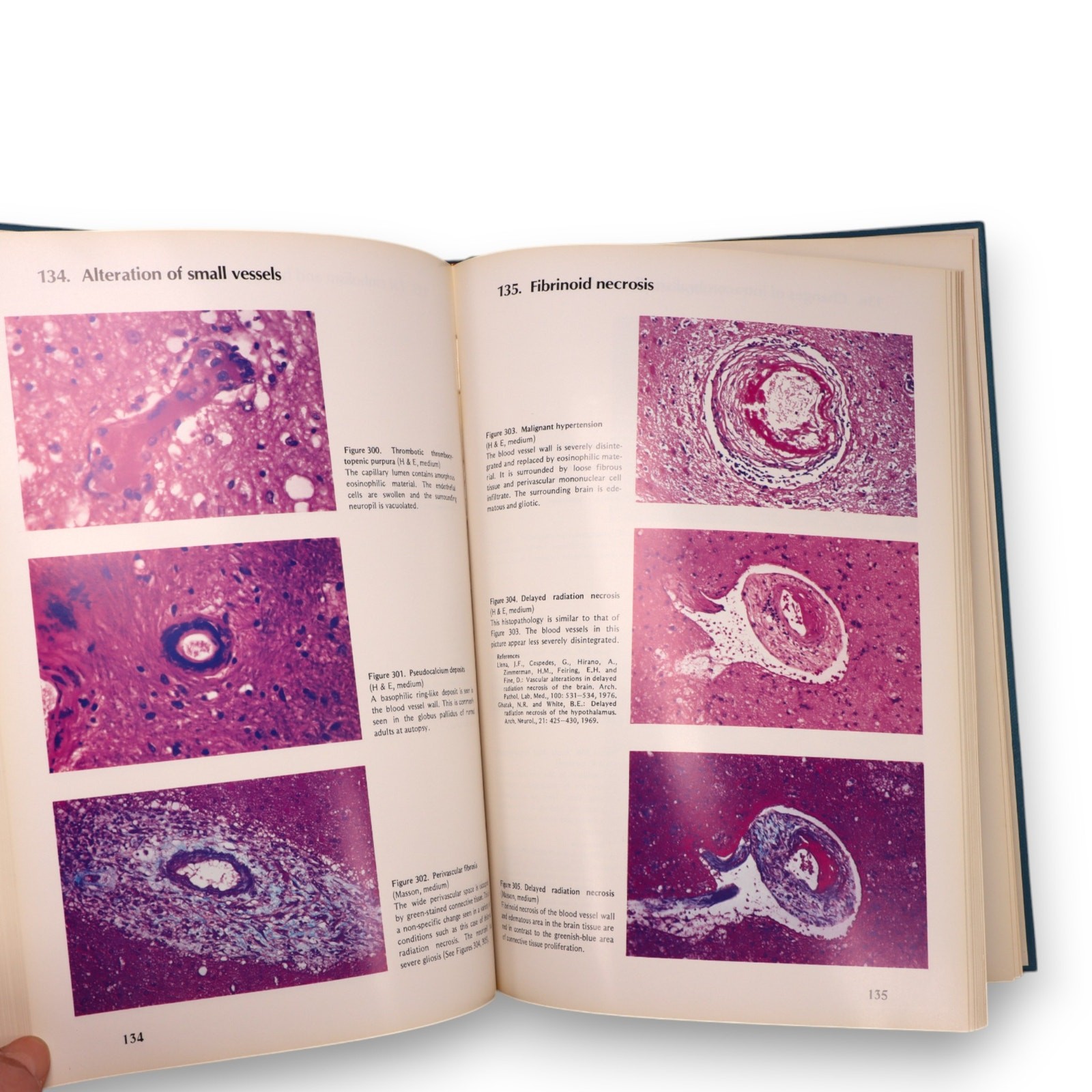 Color Atlas of Pathology of the Nervous System Hirano 1st Ed Medical Book 1980