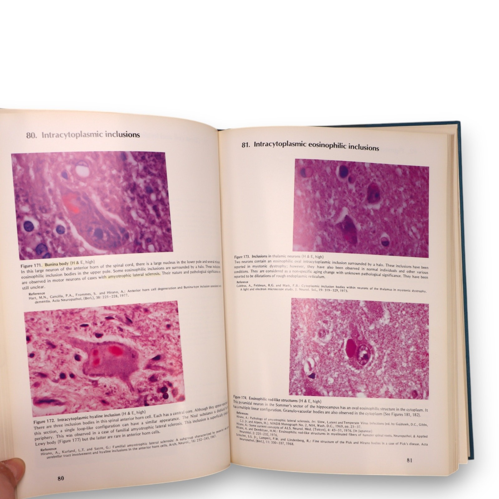 Color Atlas of Pathology of the Nervous System Hirano 1st Ed Medical Book 1980