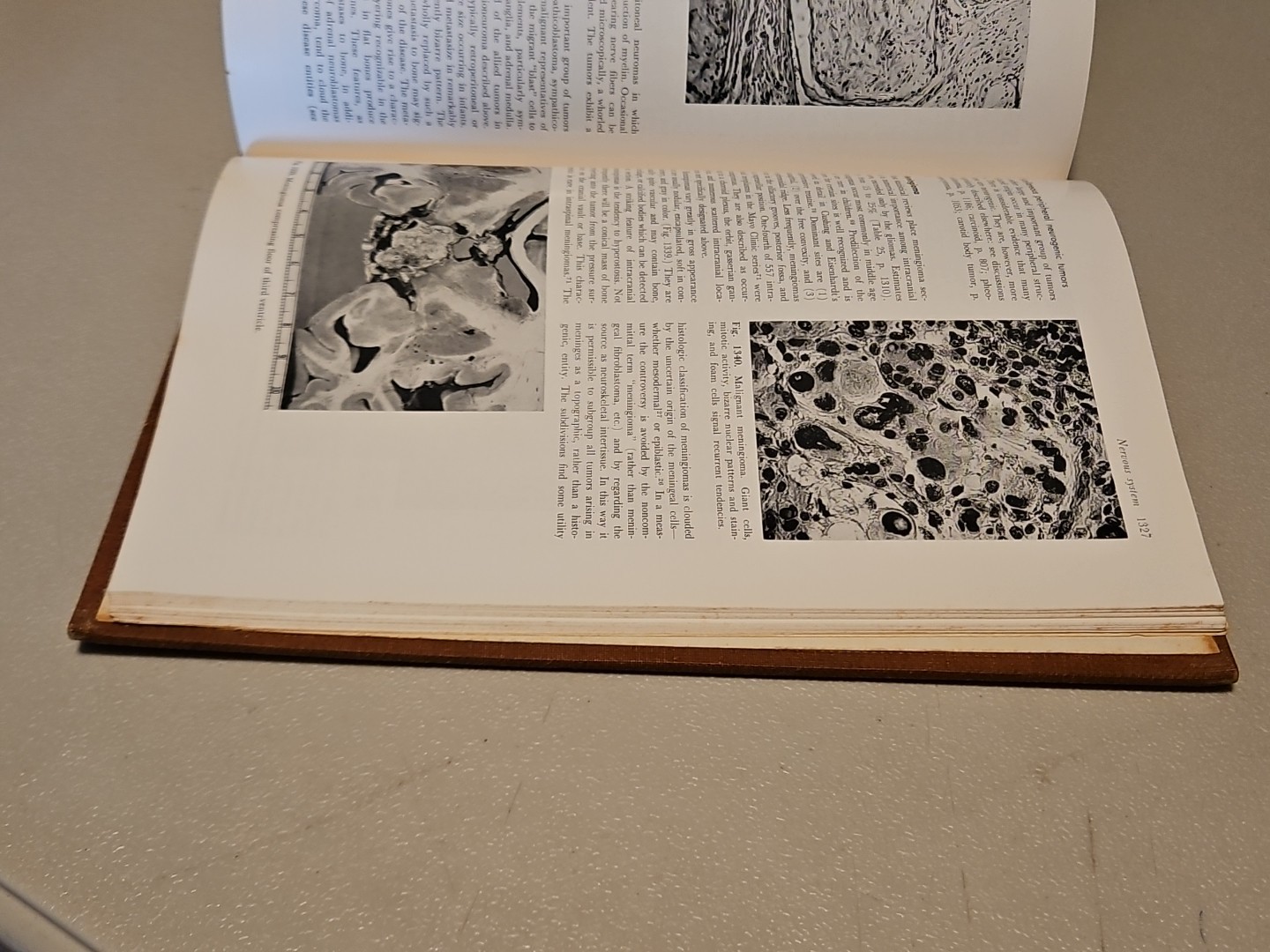 Pathology by W.A.D. Anderson 4th Edition HC Mosby 1961